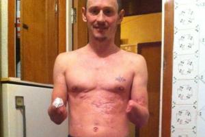 Для получения пенсии в "ДНР" от безрукого боевика требуют отпечатки пальцев