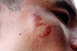 Житель Китая рассказал о взрыве iPhone 7: у мужчины повреждено лицо