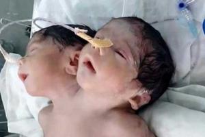 В Индии родился двухголовый младенец