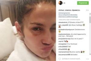 Джей Ло опубликовала снимок с фингалом под глазом