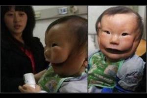 Сеть взбудоражил снимок мальчика с двумя лицами, живущего в Китае
