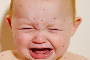 Из Румынии в Украину идет эпидемия кори: есть первые больные