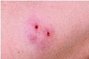 В Киеве человека укусила ядовитая змея