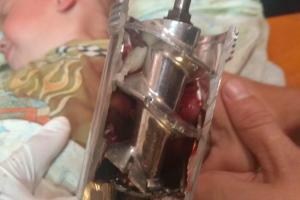 На Донетчине двухлетний мальчик засунул руку в электрическую мясорубку