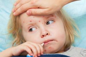 Корь атакует Украину: печальная статистика заболеваемости, симптомы болезни и советы медиков