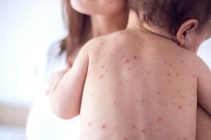 Украине грозят вспышки еще более опасных заболеваний, чем корь