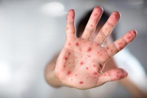 Цирк приехал вместе с корью: в Киеве больница переполнена детьми, побывавшими на представлении «Кобзова»