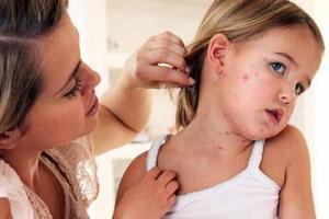 На Одесчине от осложнений после кори умер 4-летний ребенок