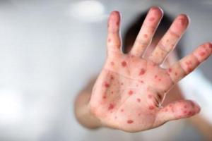 Шестая жертва: в Украине от кори умер младенец, а взрослый пациент сбежал из больницы