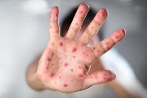 Одесскую область атакует агрессивный тип вируса кори B3 Kabul