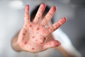 В Ужгороде из-за кори закрыли детский сад 