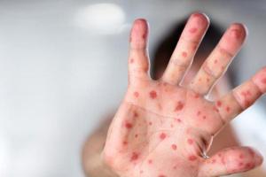 В Минздраве бьют тревогу: за неделю 1610 человек заболели корью