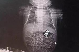 Трехлетний китаец накормил новорожденного брата гвоздями