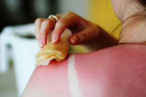 Загорать опасно: Супрун развенчала популярные летние мифы