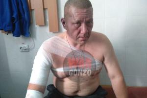 Взрыв в Донецке: В сеть выложили фото раненого кандидата в главари "ДНР" Хакимзянова