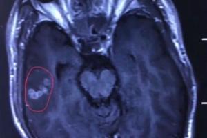 В Китае хирурги вытянули червя из мозга любителя мяса с кровью 