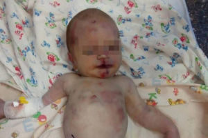 На Николаевщине в больницу подбросили жестоко избитого младенца
