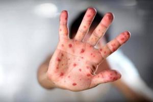 В Кременной ввели режим ЧС в связи с увеличением заболевших корью