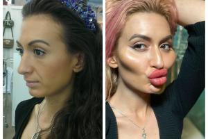 Блогерша из Киева экстремально увеличила губы и скулы: фото "до и после"