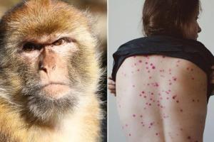 В Украине подтвердили второй случай оспы обезьян