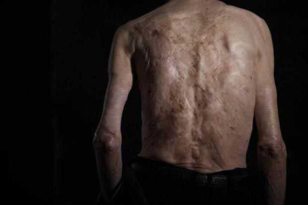 Старый японец показал шрамы, полученные "на память" о взрыве атомной бомбы Старый японец показал шрамы, полученные "на память" о взрыве атомной бомбы