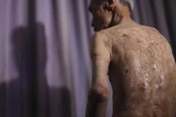 Старый японец показал шрамы, полученные "на память" о взрыве атомной бомбы Старый японец показал шрамы, полученные "на память" о взрыве атомной бомбы