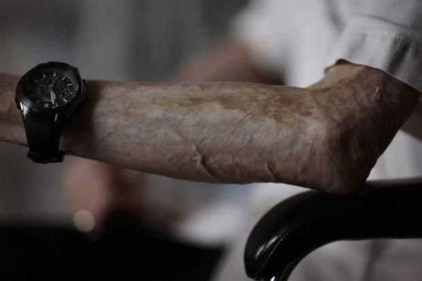 Старый японец показал шрамы, полученные "на память" о взрыве атомной бомбы Старый японец показал шрамы, полученные "на память" о взрыве атомной бомбы