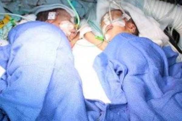 Блестящую операцию по разделению сиамских близнецов провели в швейцарском госпитале