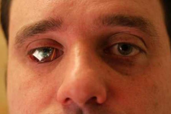 Режиссер Роб Спенсер установил камеру вместо удаленного глаза