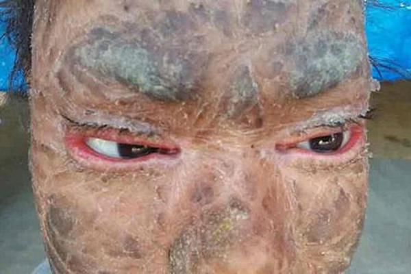 В Индии живет "девочка-змея", страдающая редким генетическим заболеванием