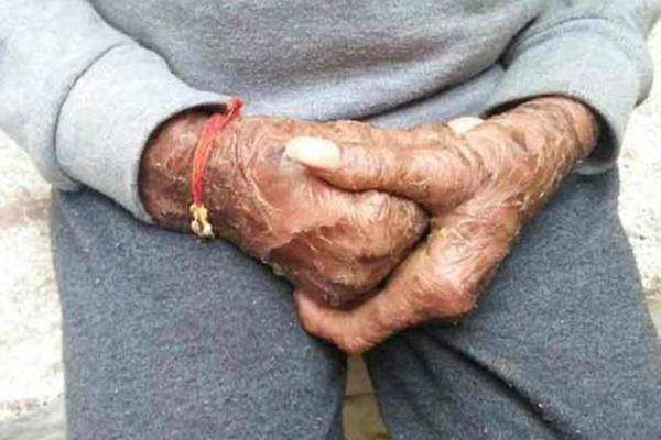 В Индии живет "девочка-змея", страдающая редким генетическим заболеванием