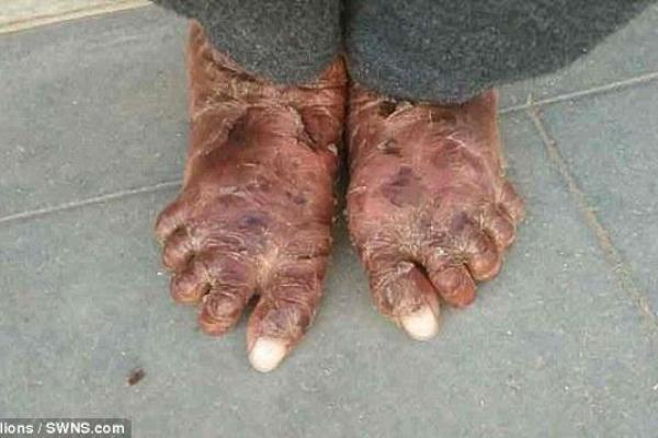 В Индии живет "девочка-змея", страдающая редким генетическим заболеванием