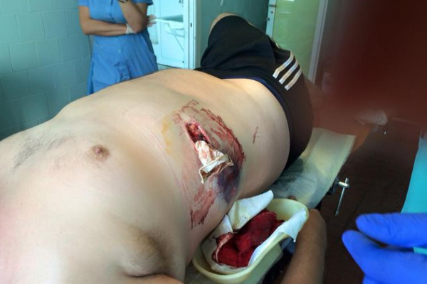 Раненый экс-министр молодежи и спорта опубликовал фото после операции