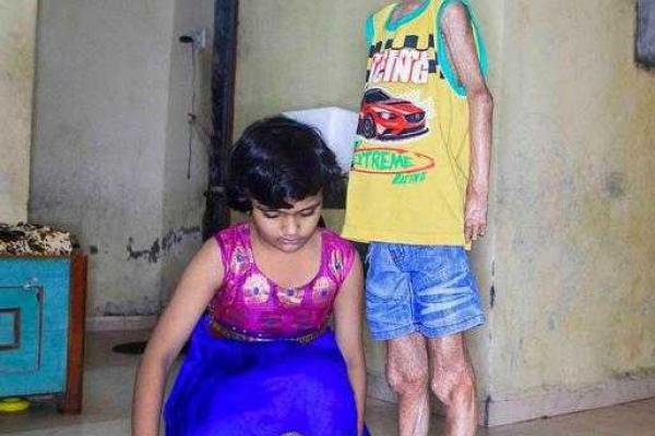 14-летний подросток из-за редкого заболевания похож на пришельца (18+) 14-летний подросток из-за редкого заболевания похож на пришельца (18+)