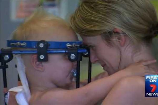 Австралийские медики спасли ребенка после внутреннего обезглавливания