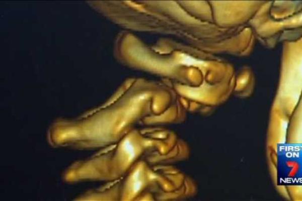 Австралийские медики спасли ребенка после внутреннего обезглавливания