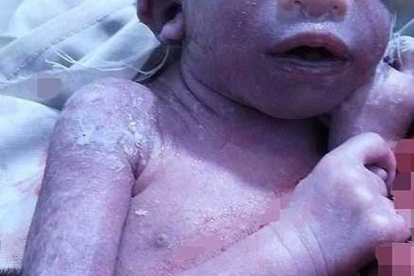 В Индии женщина родила ребенка без головы (18+)