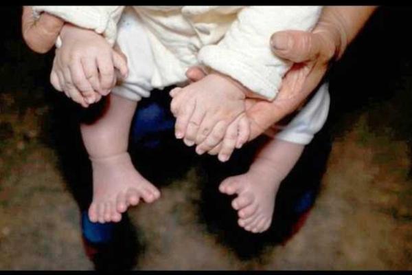 В Китае родился ребенок с 31 пальцем