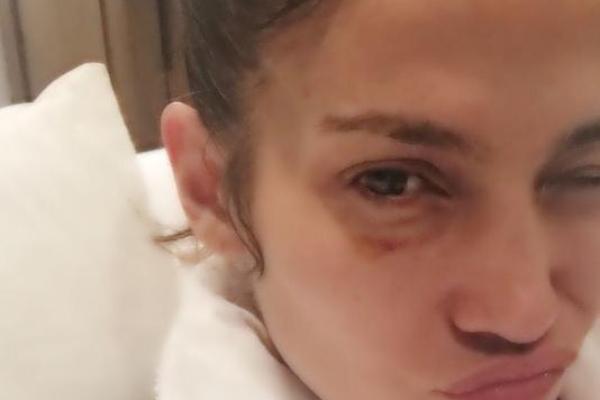 Дженнифер Лопес шокировала поклонников разбитым лицом