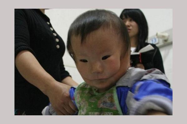 Сеть взбудоражил снимок мальчика с двумя лицами, живущего в Китае Сеть взбудоражил снимок мальчика с двумя лицами, живущего в Китае