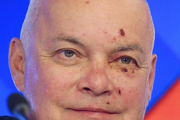 Пропагандист Киселев вернулся из Крыма с разбитым лицом Пропагандист Киселев вернулся из Крыма с разбитым лицом