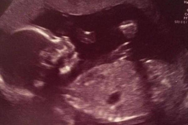 Британка, родившая мертвого ребенка, "нянчила" его еще сутки и устроила фотосессию