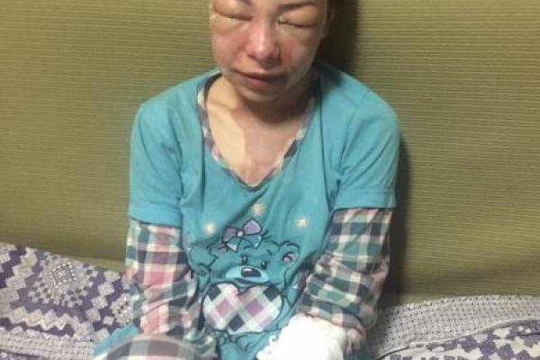 В сети появились жуткие фото женщины, которую в декабре облили кислотой
