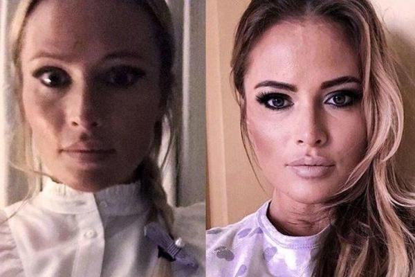 "Пять месяцев трезвой жизни": Дана Борисова показала себя до и после лечения от наркозависимости "Пять месяцев трезвой жизни": Дана Борисова показала себя до и после лечения от наркозависимости